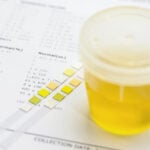 Reagent strip used for urinalysis with a vial of collected Urine